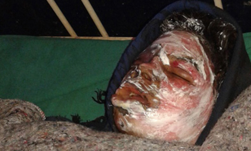 मटि्टतेल छर्केर अनिशाको शरीरमा आगो लगाएपछि..